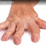 Il vaccino ricombinante per l'epatite B può innescare lo sviluppo di artrite reumatoide