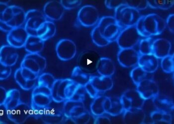 Il sangue dei vaccinati  mostra "accatastamento", tipico del cancro del sangue