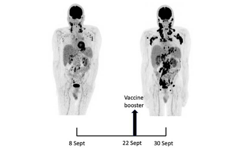 Rapida progressione di un tipo di cancro dopo seconda dose del vaccino mRNA Pfizer