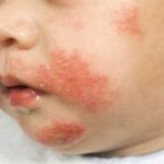 Studio: la gelatina nei vaccini può causare reazioni allergiche sistemiche nei bambini