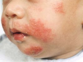 Studio: la gelatina nei vaccini può causare reazioni allergiche sistemiche nei bambini