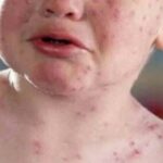 Ci si può ammalare di morbillo a causa del vaccino anti-morbillo?