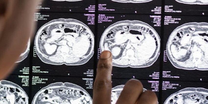 26enne con encefalomielite acuta disseminata dopo la vaccinazione contro SARS-CoV-2: un caso clinico