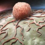 "SV40: un virus oncogenico emergente che causa tumori umani"
