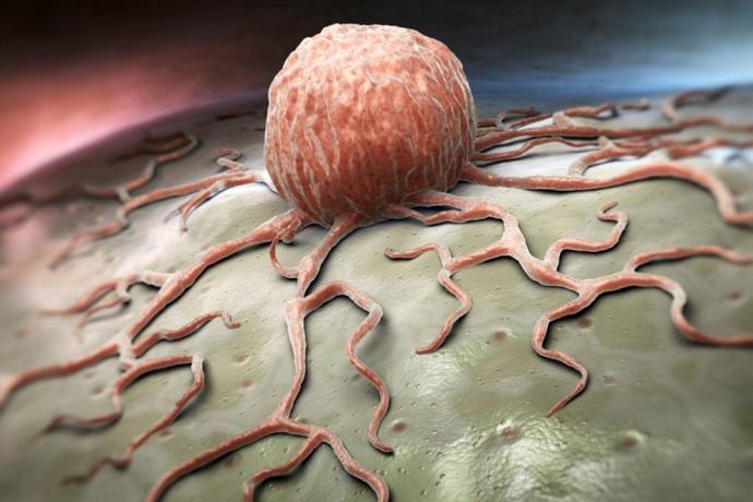 “SV40: un virus oncogenico emergente che causa tumori umani”