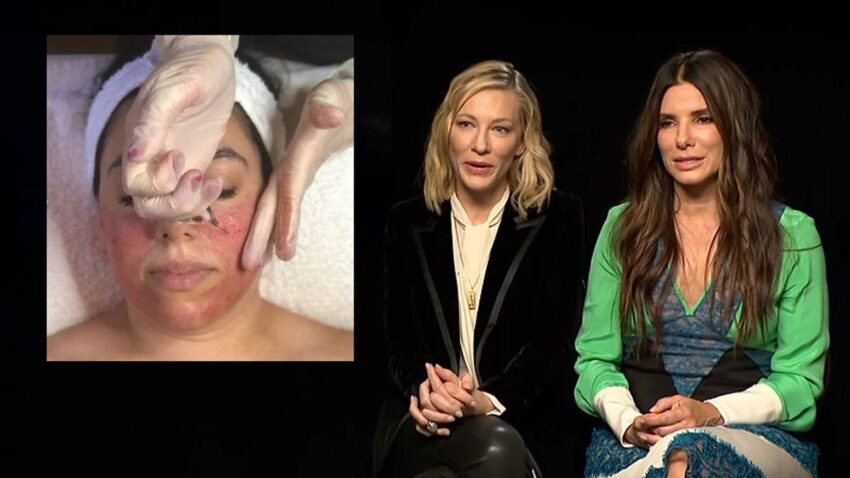 Sandra Bullock e Cate Blanchett: il prepuzio dei neonati come rimedio anti-età