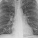Popolazioni non vaccinate con vaccino antipolio contaminato SV40 hanno pochi casi di mesotelioma.