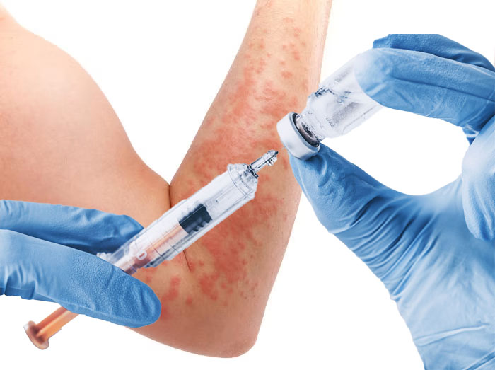 Dermatite allergica da contatto sistemica, dopo vaccinazione influenzale contenente formaldeide